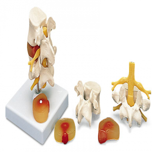 2節(jié)腰椎帶2個(gè)病變椎間盤模型